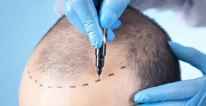 Trasplante de Cabello: ¿Cómo Funciona y Cuáles Son sus Tasas de Éxito?