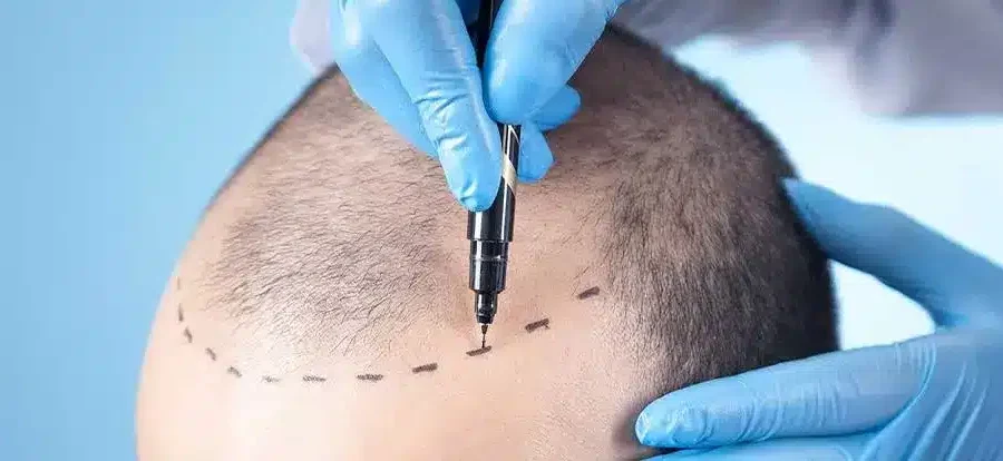 Trasplante de Cabello: ¿Cómo Funciona y Cuáles Son sus Tasas de Éxito?