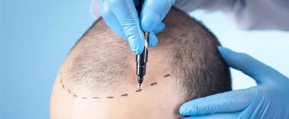 Trasplante de Cabello: ¿Cómo Funciona y Cuáles Son sus Tasas de Éxito?